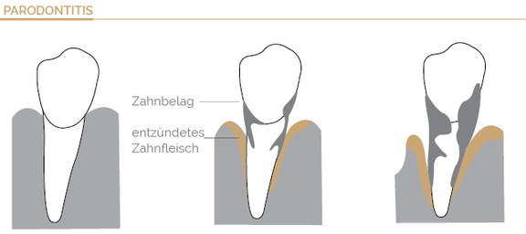 Parodontitis, Zahnarzt Böblingen, Dr. Wagner